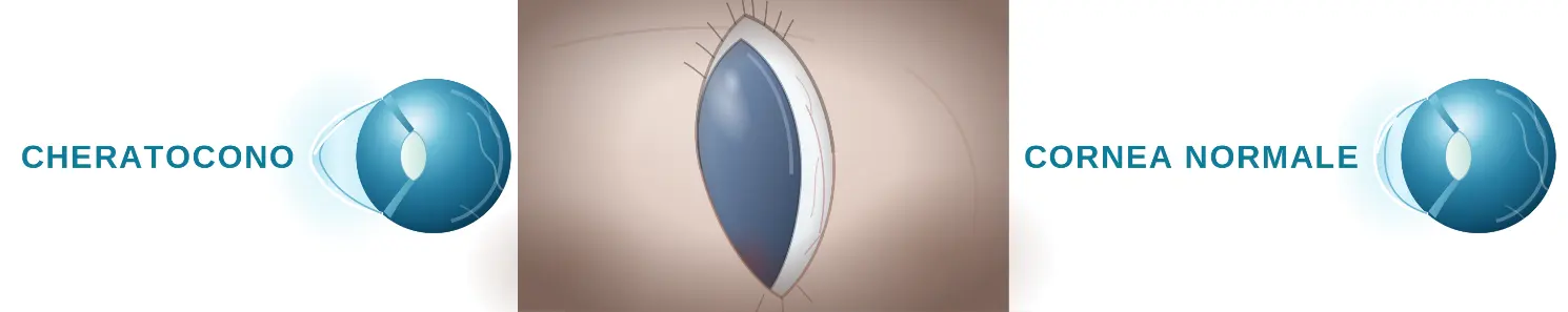 Esame della cornea per la diagnosi del cheratocono
