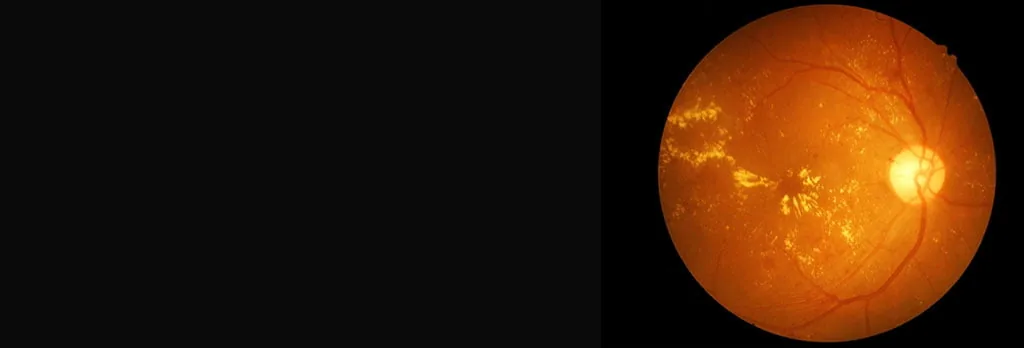 Immagine del fondo oculare e della retina