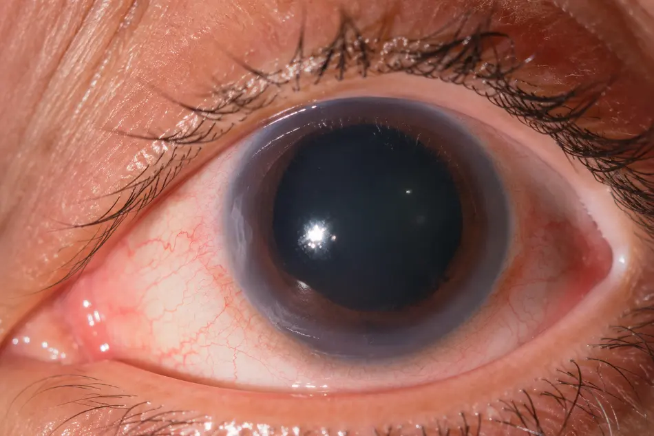 Rappresentazione del glaucoma e del nervo ottico