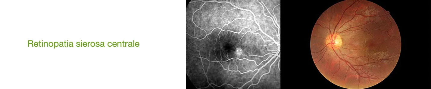 RETINOPATIA SIEROSA CENTRALE